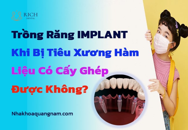 Trồng răng implant khi bị tiêu xương hàm