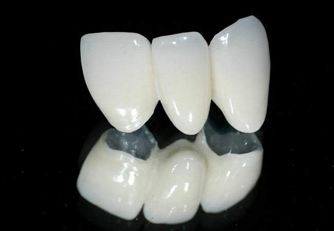 Răng sứ Ceramill là dòng răng sứ không chứa kim loại